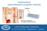Стентирование при гастроинтестинальных стромальных опухолях. nairimed.com