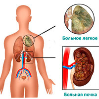 Синдром Гудпасчера &ndash; главное открытие стипендиата Фонда Рокфеллера