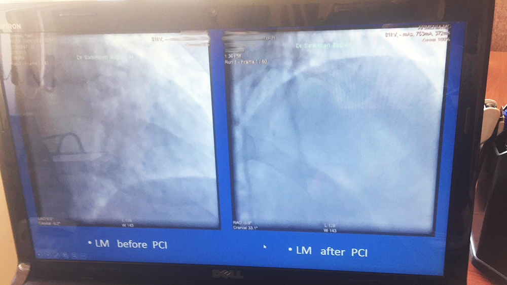 Կլինիկական դեպք. &ldquo;Stent for life&rdquo; ՀՀ պետական ծրագրի շրջանակներում