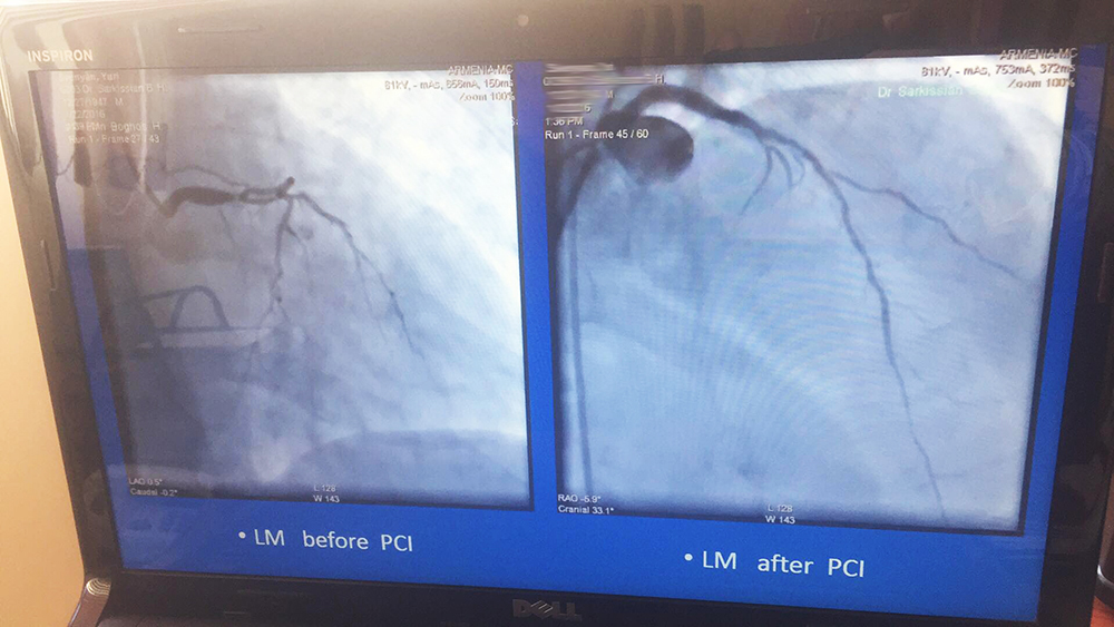 Կլինիկական դեպք. &ldquo;Stent for life&rdquo; ՀՀ պետական ծրագրի շրջանակներում