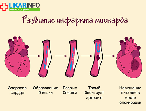Инфаркт у женщин &ndash; атипичные