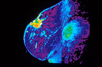 ՄՌ-մամոգրաֆիայի նոր մեթոդի ներդրումը &laquo;Իզմիրլյան&raquo; ԲԿ ճառագայթային բաժանմունքում
